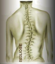 Escoliose