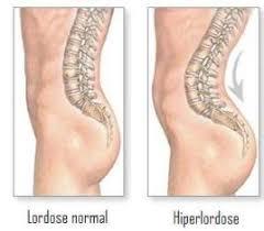 Hiperlordose