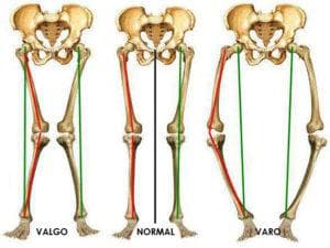 joelho-valgo-joelho-varo-jolho-normal